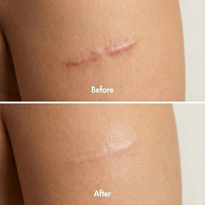 Derva™ Scar Solutions Silicone Stick